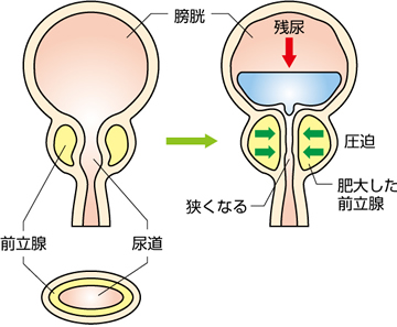 前立腺が肥大すると、膀胱や尿道を圧迫します。